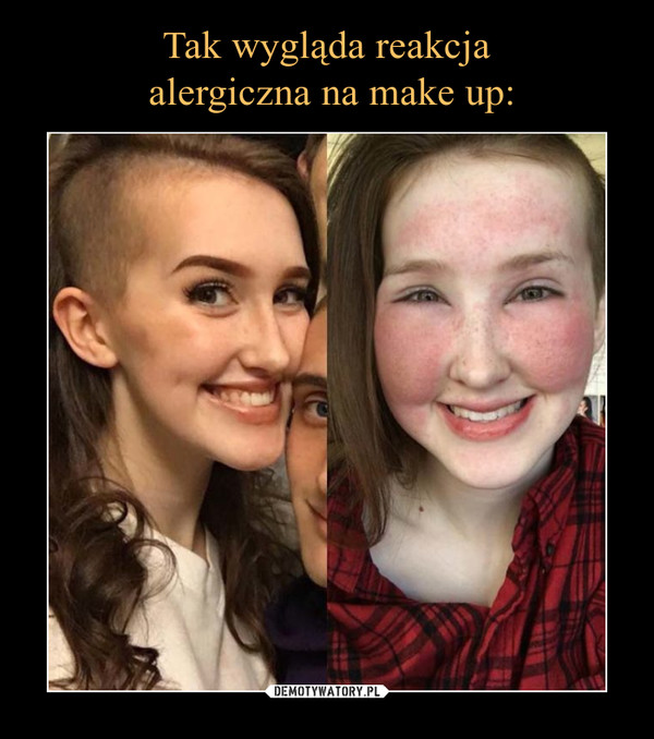 Tak wygląda reakcja
 alergiczna na make up:
