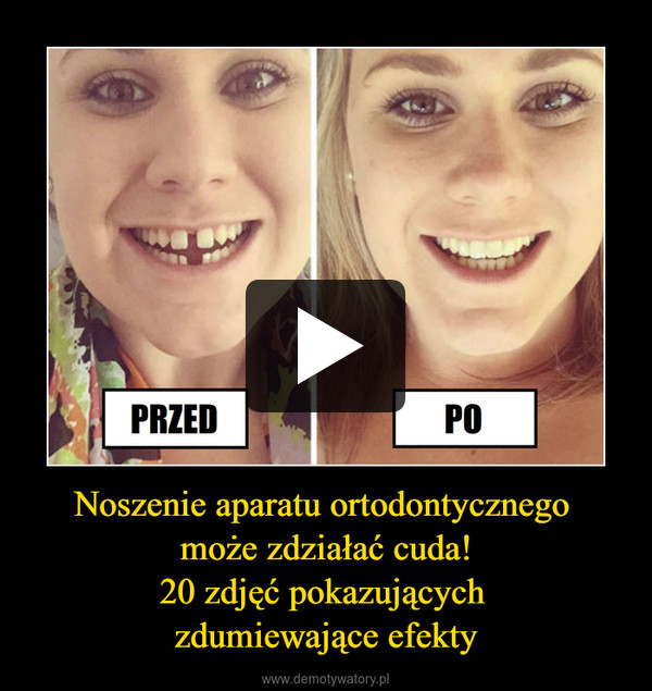Noszenie aparatu ortodontycznego może zdziałać cuda!20 zdjęć pokazujących zdumiewające efekty –  
