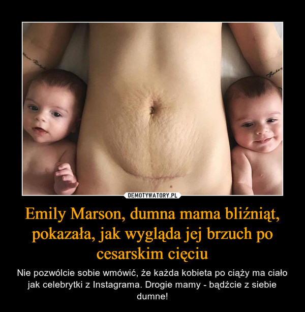 Emily Marson, dumna mama bliźniąt, pokazała, jak wygląda jej brzuch po cesarskim cięciu